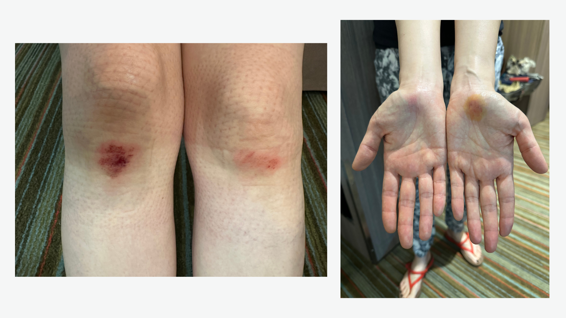Scrapped-Hands-Knees Scrapped Hands Knees